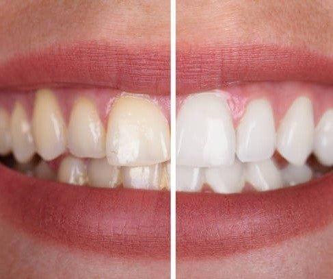 SmileKit™ | Je voelt je zelfverzekerder met een frisse, stralende lach die lang houdt