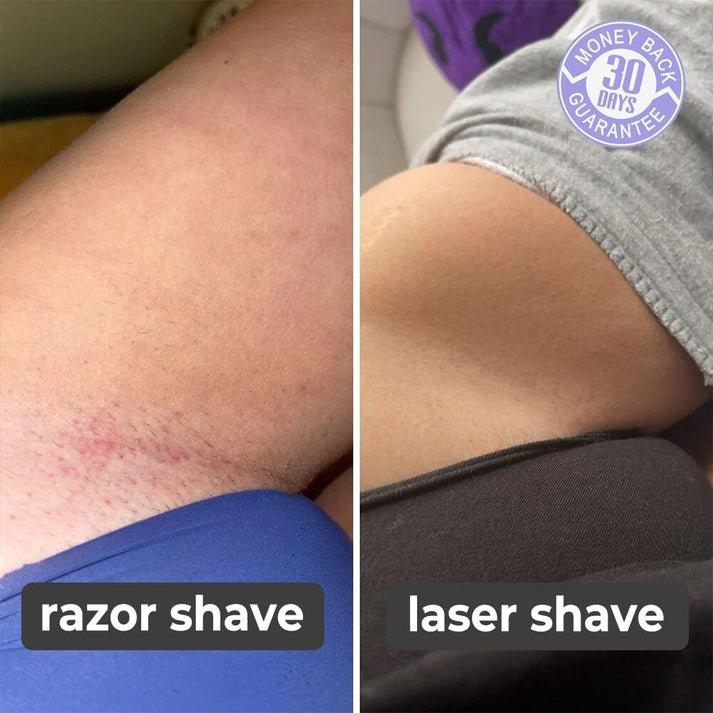 SmoothBeam™ | Pijnloze Epilatie